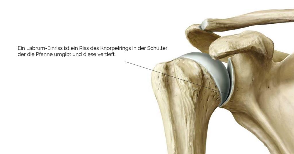 christine scheyer labrumriss rechte schulter